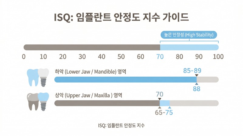 전체-임플란트-ISQ-임플란트-골융합-측정.jpg